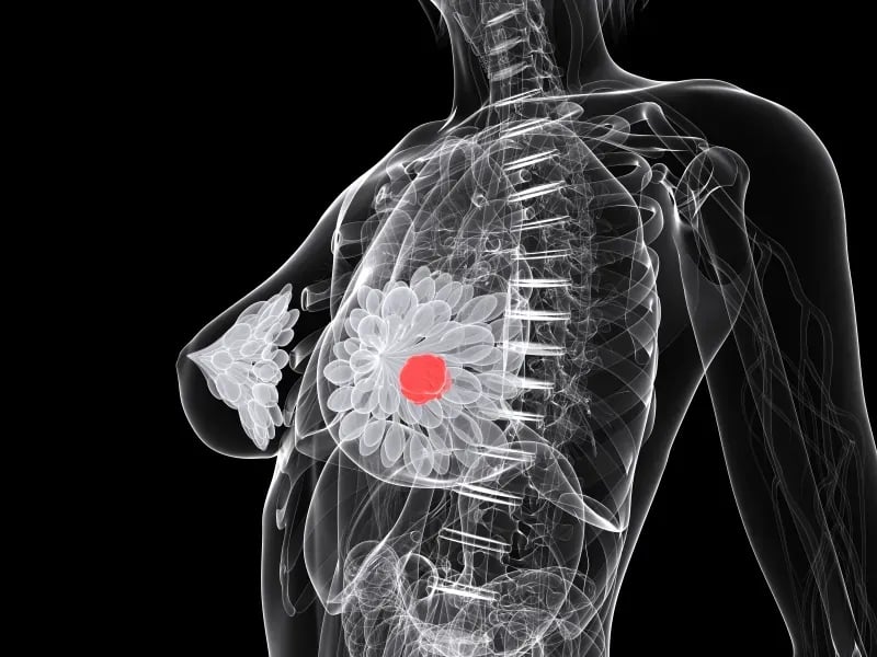 Virus may obliterate triple-negative breast cancer!